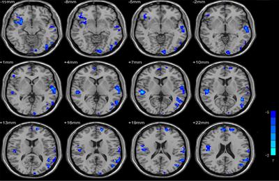 Internet Search Alters Intra- and Inter-regional Synchronization in the Temporal Gyrus